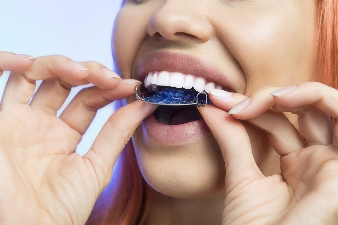 Posizionamento del bite per denti