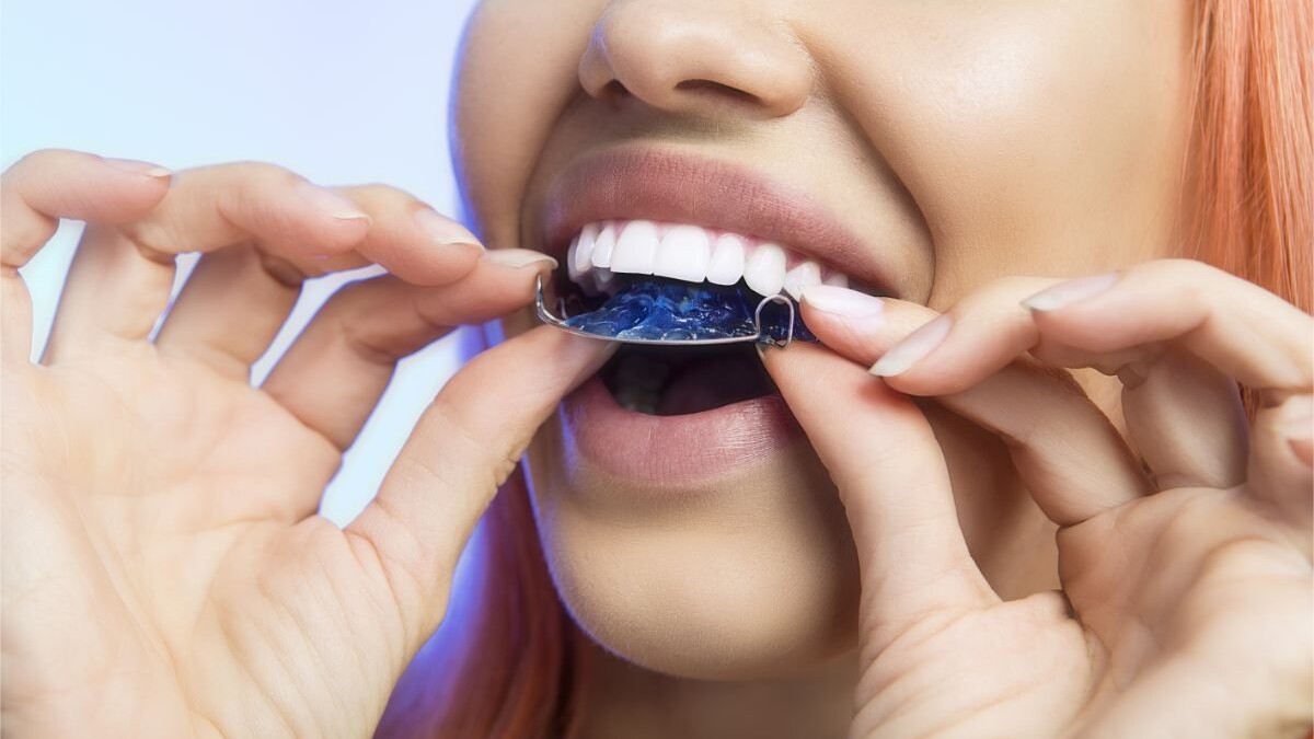 Posizionamento del bite per denti