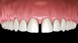 spazio tra i denti incisivi