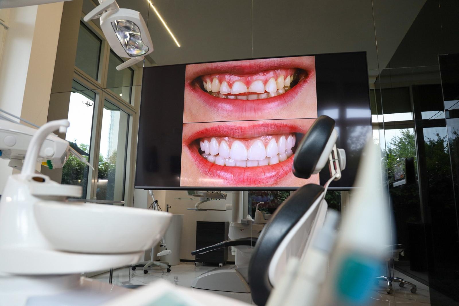 Valutazione del sorriso prima di un trattamento con faccette dentali